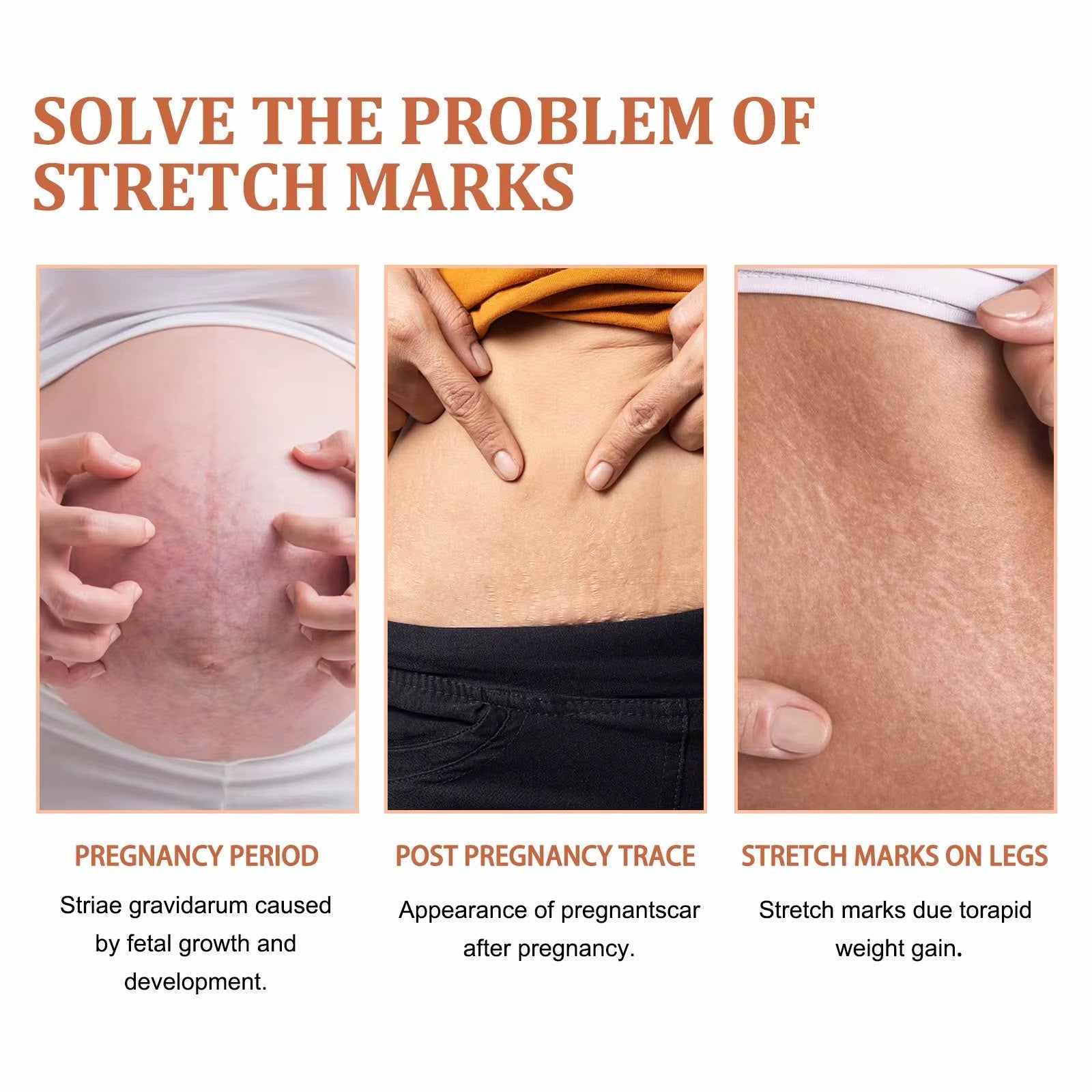 Best Stretch Mark Cream For Pregnancy & Repair Skincare